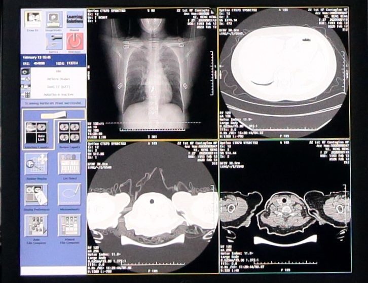 aplicação da tecnologia de IA contra pandemia de covid-19